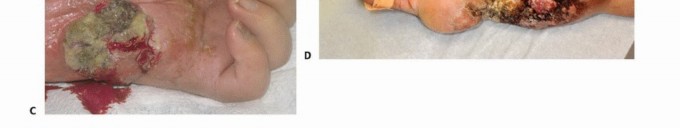Illustration 7 for Above-Elbow & Below-Elbow Amputations: When & Why They're Needed