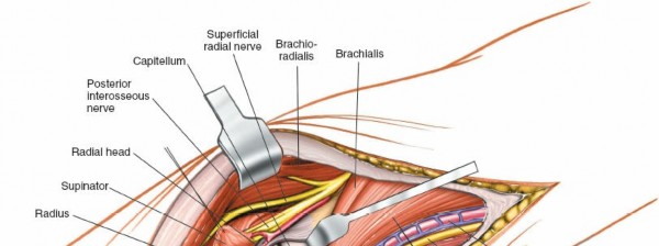 Illustration 84 for Mastering Elbow Approaches: Applied Surgical Anatomy for Precision