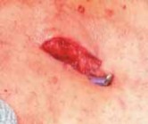 Illustration 21 for Pediatric Tibial Fractures: Avoid Mistakes, Ensure Optimal Healing