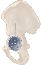 Illustration 45 for Mastering the Cementless Acetabular Cup: Techniques for Optimal Fixation