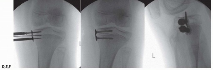 Illustration 16 for Optimizing Growth to Correct Pediatric Limb Deformities