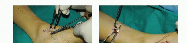 Illustration 26 for Foot Drop Surgery: How a Pin or Drill Elevates Tendon Transfer