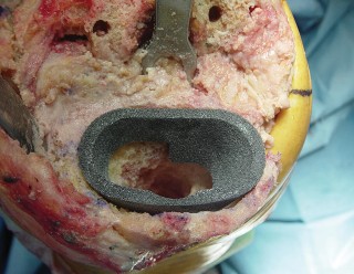 Illustration 11 for Porous Metal Cones: Biologic Fixation for Severe Bone Loss