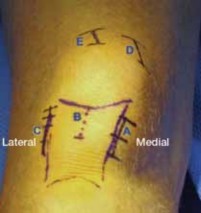 Illustration 27 for Optimal Nailing of the Tibia: Techniques for Challenging Fractures