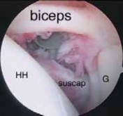 Illustration 19 for Capsular Releases for Loss of Motion: Restore Your Shoulder