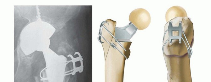 Illustration 11 for Overcoming Proximal Femoral Bone Loss: Fluted Stems in Revision THA
