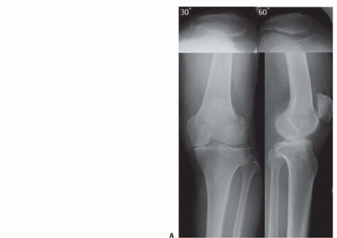 Illustration 26 for High Tibial Osteotomy: Realignment for Lasting Knee Pain Relief