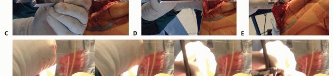 Illustration 8 for Removal of Well-fixed Components: Safe Techniques for Revision TKA