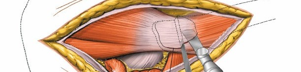 Illustration 127 for Pelvis & Acetabulum Approaches: Unlocking the Posterior Superior Iliac