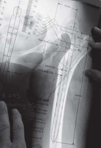 Illustration 33 for Successful Total Hip Replacement in Developmental Dysplasia