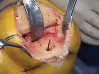 Illustration 13 for Minimal Incision Total Knee: Experience Faster Healing