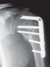 Illustration 5 for Capsular Releases for Loss of Motion: Restore Your Shoulder