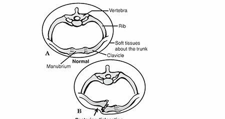 Illustration of joint injury sternoclavicular - Dr. Mohammed Hutaif
