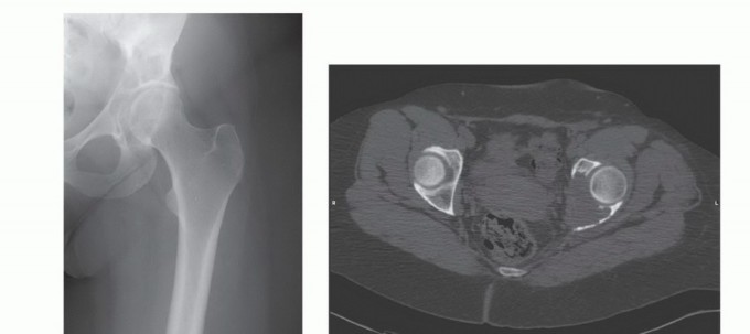 Illustration 10 for Pelvic Metastasis Surgery: A Component of the Utilitarian Approach