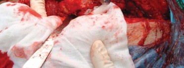 Illustration 145 for Successful Total Hip Replacement in Developmental Dysplasia