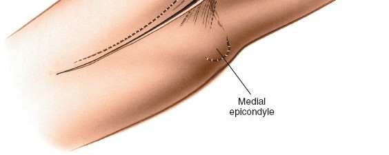 Illustration 53 for Mastering Elbow Approaches: Applied Surgical Anatomy for Precision