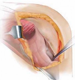 Achieving Optimal Extensile Exposure: Tibial Tubercle Osteotomy