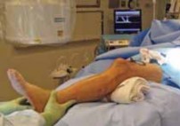 Illustration 23 for Optimal Nailing of the Tibia: Techniques for Challenging Fractures