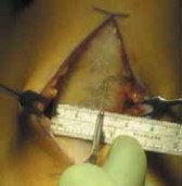 Illustration 8 for Optimizing Single-Bundle Anterior Cruciate Ligament Repair