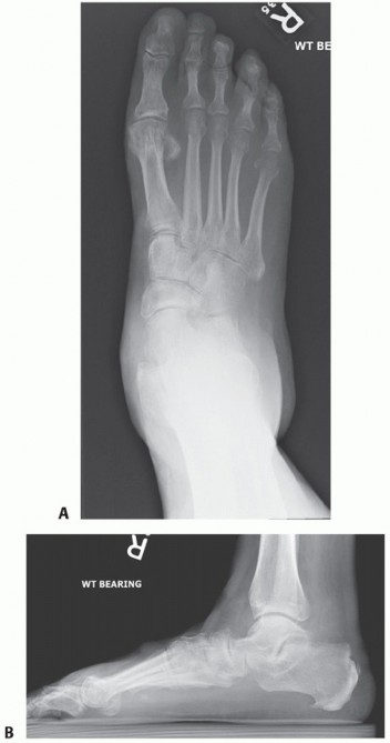 Traditional Triple Arthrodesis: Fixing Severe Foot Deformity