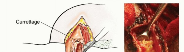 Illustration 15 for Restore Vital Function: Surgery for Type II Humeral Metastasis