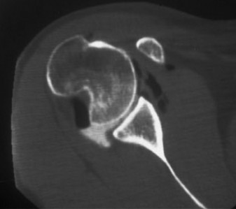 Elbow & Shoulder Cases: Spotting Critical Hill-Sachs Lesions