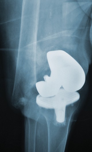 Illustration 18 for Hinged Total Knee: The Salvage Solution for Challenging Cases