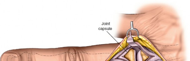 Illustration 3 for Unlock Easier Access: Dorsal Approach for Phalanges and Interphalangeal Joints