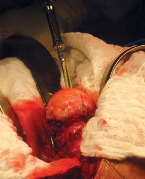 Illustration 50 for Metal on Metal Resurfacing: Enhanced Posterior Soft Tissue Repair