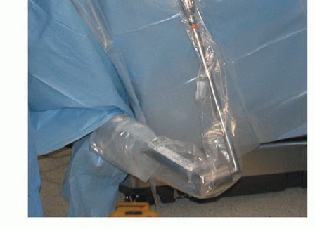 Illustration 9 for Stiff Shoulder? Discover Arthroscopic Capsular Release Solutions