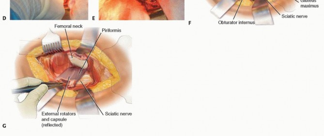 Illustration 46 for Hemiarthroplasty of the Hip: Indications & Types Explained