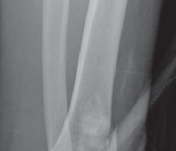 Illustration 33 for Optimizing ORIF for Tibial Plafond Fractures: A Modern Approach