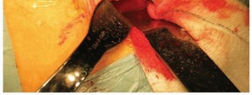 Illustration 33 for Why Polished Tapered Cemented Stems Excel in Hip Replacement