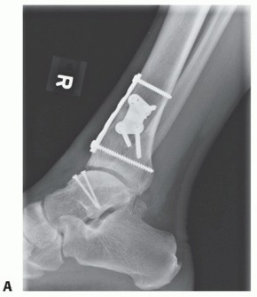 Illustration 49 for Unlock Healing: Medial Malleolar Osteotomy for Talus OLT Allografts