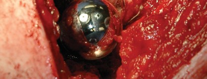 Illustration 112 for Femoral Stem Revision: Posterior Approach for Better Outcomes