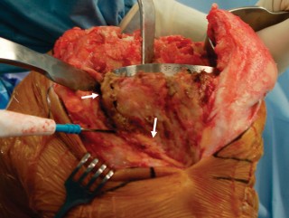 Illustration 32 for Precision Soft Tissue Balancing in Revision: Avoid TKA Pitfalls