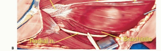 Illustration 10 for Distal Humeral Resection: Safe Techniques for Limb Preservation