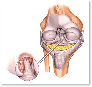 Illustration of superficial medial ligament - Dr. Mohammed Hutaif