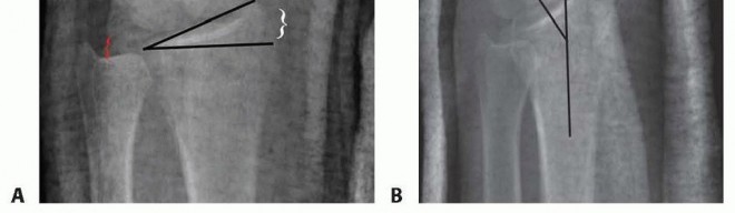 Illustration 4 for Distal Radius Fixation: Precision Through Lister's Tubercle