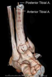 Illustration 22 for Optimizing ORIF for Tibial Plafond Fractures: A Modern Approach