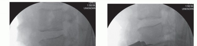Illustration 5 for Anterior Lumbar Interbody: Fusion, Disc Replacement & Pain Relief