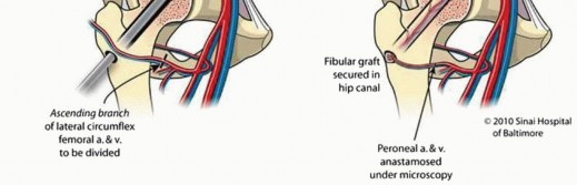 Illustration 12 for Head-Sparing for Osteonecrosis of the Femoral: Preserve Your Hip