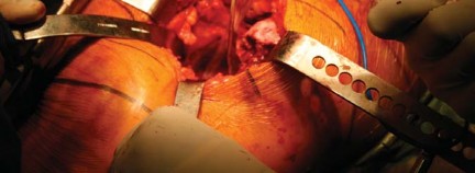 Illustration 30 for Metal on Metal Resurfacing: Enhanced Posterior Soft Tissue Repair