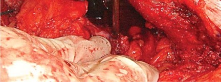 صورة طبية: إتقان توازن الأنسجة الرخوة لمفصل ورك صناعي مثالي: دليل شامل للمرضى مع الأستاذ الدكتور محمد هطيف