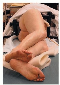 Illustration 5 for Hip Reimplantation Surgery: The Solution for Infected Implants