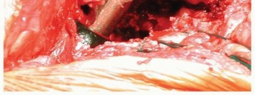 Illustration 19 for Why Polished Tapered Cemented Stems Excel in Hip Replacement