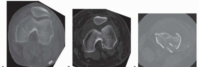 Illustration 12 for Repairing Distal Femur Fractures: Open Reduction & Internal Fixation