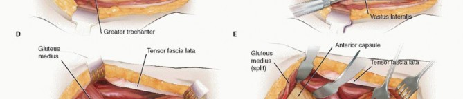 Illustration 9 for Proximal Femoral Osteotomy: When This Hip-Saving Surgery Is Performed