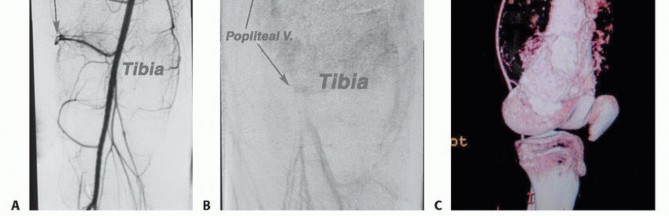 Illustration 16 for Advanced Distal Femoral Resections: Limb-Sparing Outcomes & Techniques