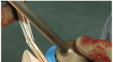 Illustration 9 for Cemented Acetabular Component: Achieving Optimal THA Stability